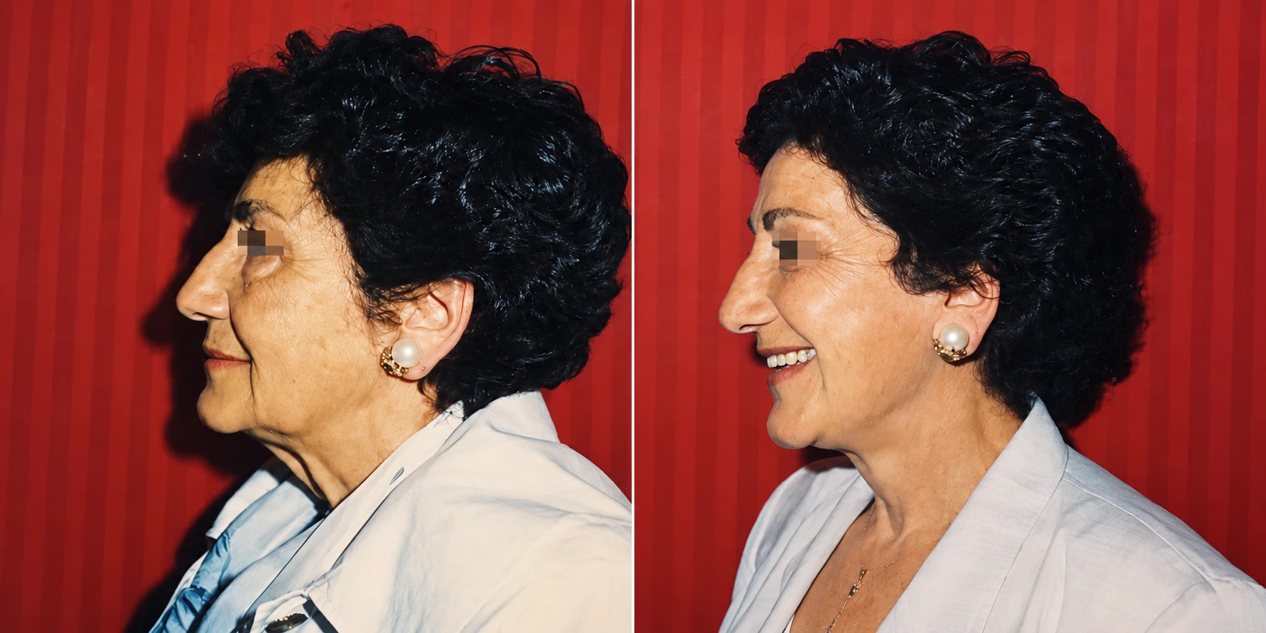 Lifting facciale — a sinistra prima, a destra dopo l'intervento