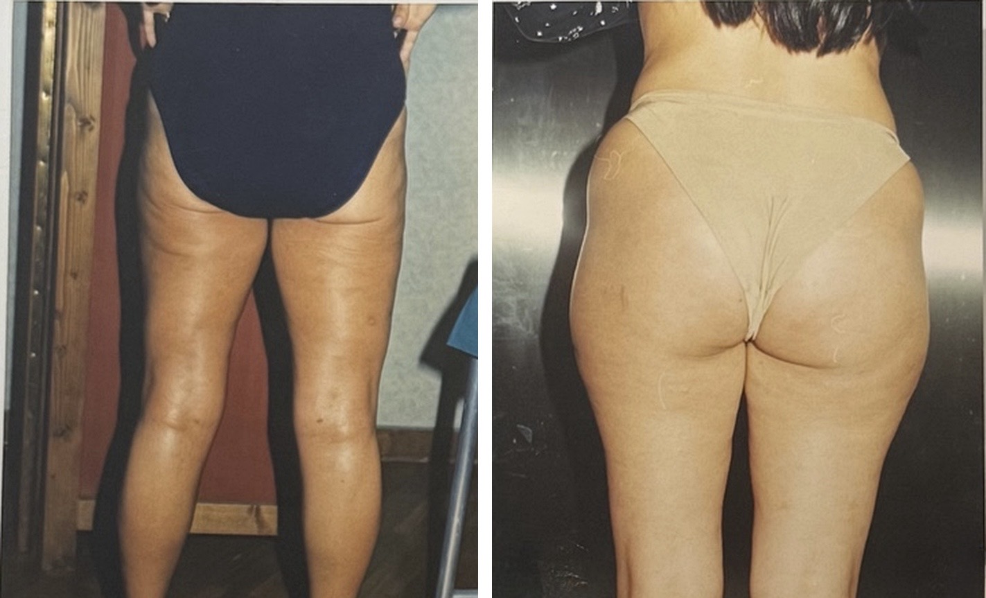 Liposuzione — a sinistra prima, a destra dopo l'intervento